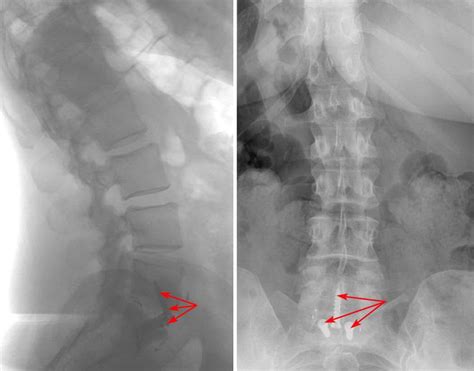 Spinal Fusion: Anterior Lumbar Interbody Fusion - OrthoInfo - AAOS