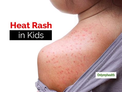 Heat Rash: Prickly Heat Rash Sweat Rash Pictures, Symptoms Treatment | vlr.eng.br