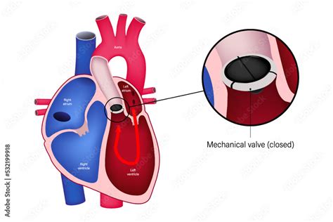 Aortic valve replacement with mechanical valve. Close up of open mechanical valve. Heart anatomy ...