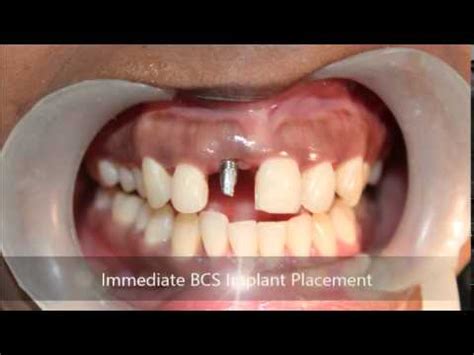 Severe gum abscess tooth extraction and immediate BCS implant placement! - YouTube