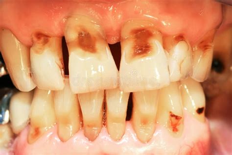 Teeth Abrasion Stock Photos - Image: 28636143