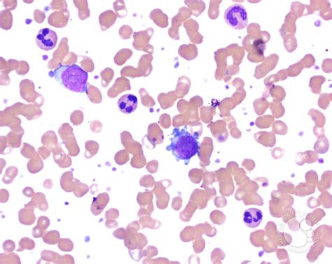 Micromegakaryocytes in peripheral blood smear - 1.