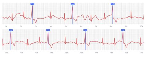 What Ventricular Trigeminy Looks Like on Your Watch ECG | Qaly