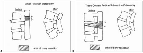 Smith-Petersen Osteotomy and Pedicle Subtraction Osteotomy | Musculoskeletal Key