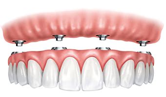 How much do Snap-On Dentures Cost?