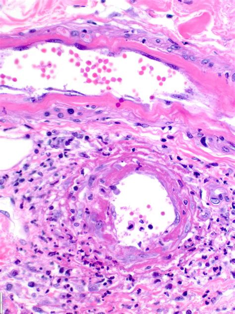 Leukocytoclastic Vasculitis Histology