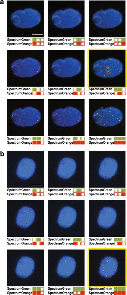 Detection of ALK-rearrangement and gain of ALK-native copies in CTCs... | Download Scientific ...