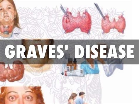 Graves' Disease: 10 Graves' Disease Symptoms