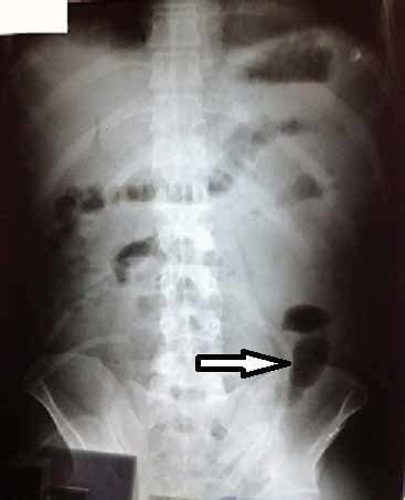 Plain X-ray revealed valvula conniventes and dilated gas filled small... | Download Scientific ...