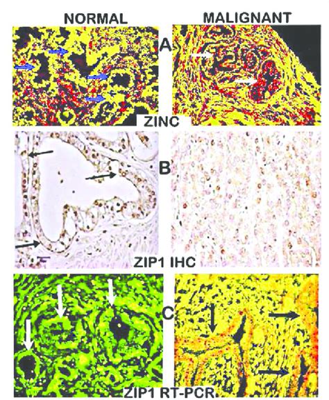 Human normal prostate peripheral zone and prostate cancer tissue... | Download Scientific Diagram