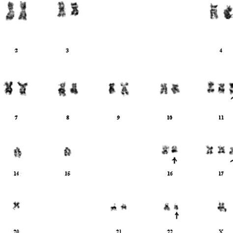 Conventional karyotyping on cultured tumor cells showing aneuploid,... | Download Scientific Diagram