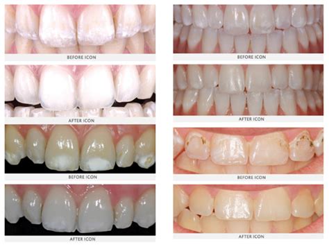 How To Prevent White Spots On Teeth - Rowwhole3