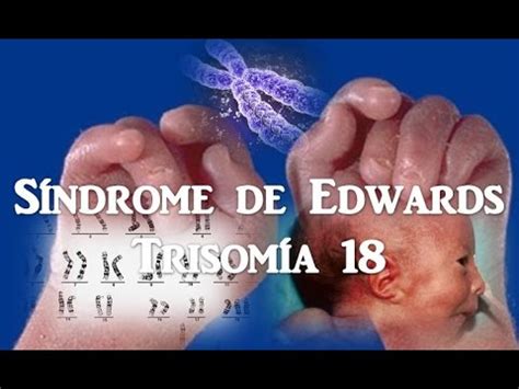 Sindrome De Edwards Cajaivjo Youtube