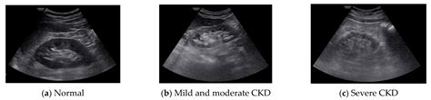 Normal Pediatric Renal Ultrasound