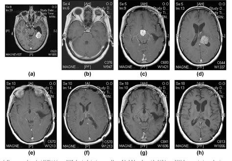 Figure 1 from Progression of choroid plexus papilloma | Semantic Scholar