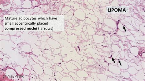 Pathology of Lipoma | Pathology Made Simple