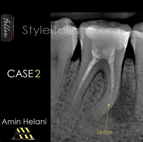 Management of ledge formation - Style Italiano Endodontics