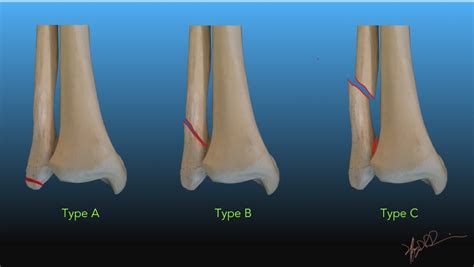 A Review of Distal Fibula Fractures - Sports Medicine Review