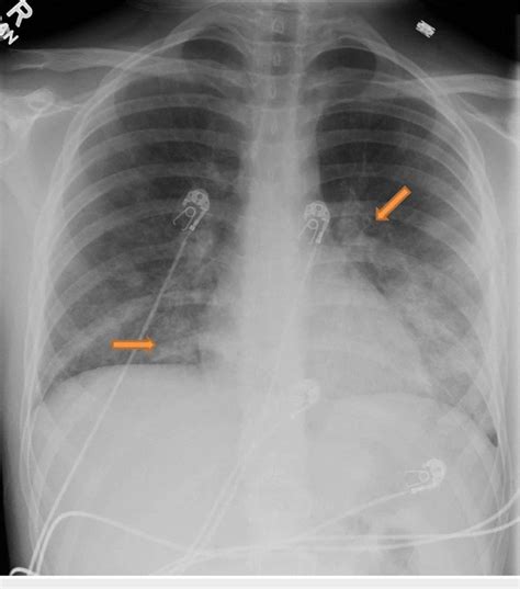 Left perihilar and right lower lobe basilar infiltrates most consistent... | Download Scientific ...