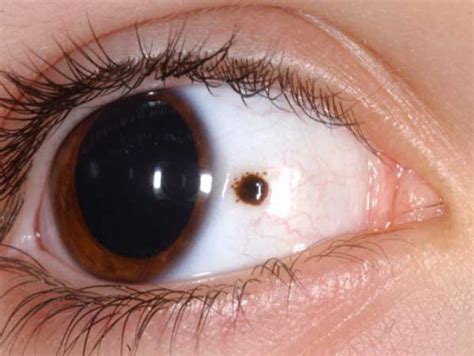 Dark Spot on the sclera of eye? What is it!