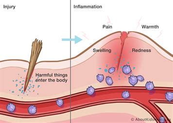 Inflammatory Response Study Guide - Inspirit