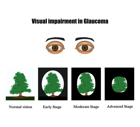 Glaucoma – Risk Factors, Symptoms & Treatment - Davis Eyecare