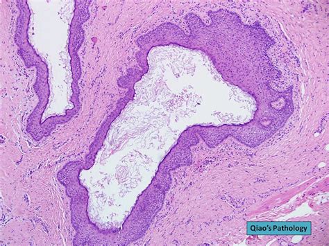 Qiao's Pathology: Preauricular First Branchial Cleft Cyst … | Flickr