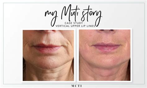 Vertical lip lines or wrinkles case study - theGoodSkinPlace