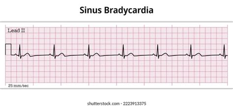 Vektor Stok Ecg Sinus Bradycardia 8 Second Ecg (Tanpa Royalti) 2223913375 | Shutterstock