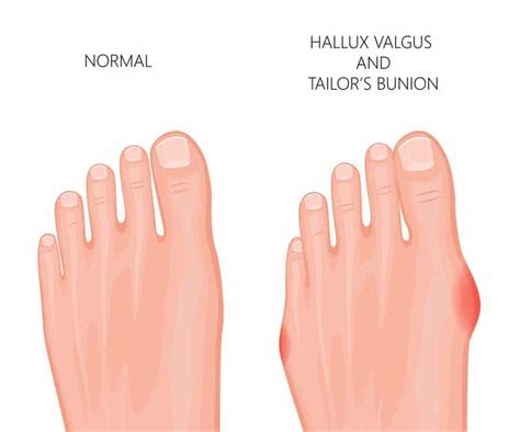 What Is A Bunion - (Find Out All About Bunions & Their Causes)