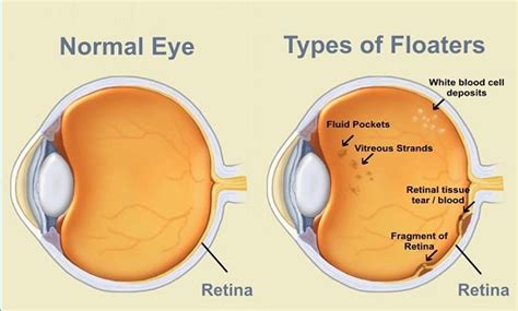 An eye floater looks like a speck in your vision that moves when you look around. Eye floaters ...