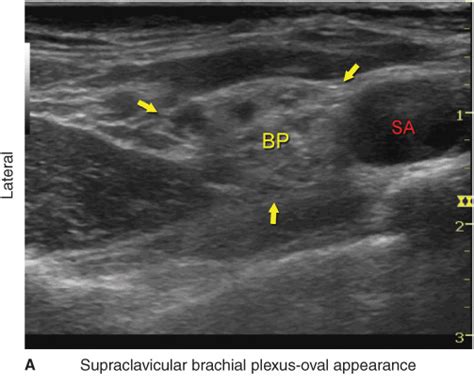 Ultrasound-Guided Supraclavicular Brachial Plexus Block | Anesthesia Key