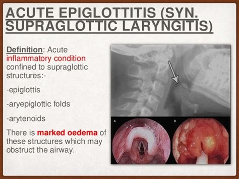 Apa Fungsi Epiglotis Ilmu - vrogue.co