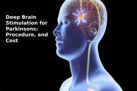 Deep Brain Stimulation for Parkinsons: Procedure, and Cost - 2021