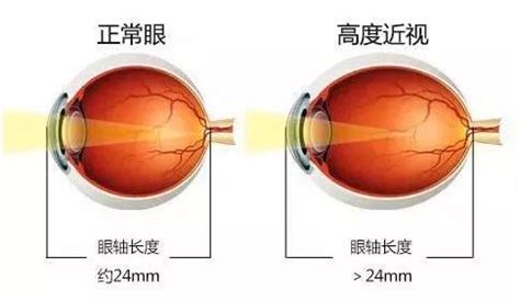 近视眼镜戴久了眼球会突出，怎么办？看完这篇你就懂了！_戴眼镜