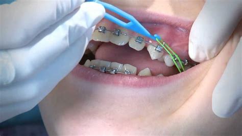 How To Enjoy Perfect Dental Braces For Your Teeth - Global Health Blog