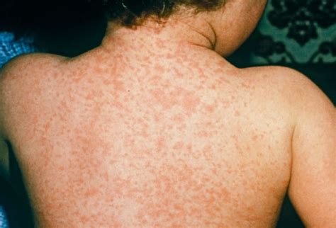 Measles Rash - Pictures, Symptoms, Causes, Treatment, Home Remedies ...