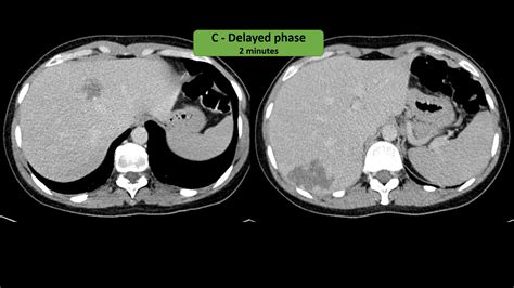 Hepatic Hemangiomas - Manal's Classroom