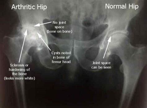 Osteophytes Hip