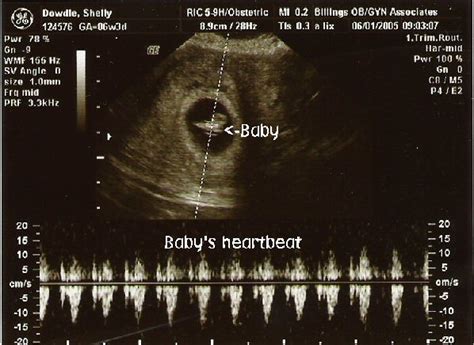 baby ultrasound