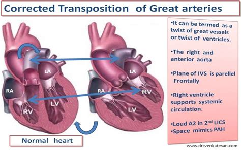 Image result for transposition of the great vessels | Arteries, Congenital heart defect ...