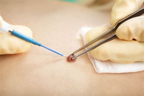 Mole Removal London (£345) - Skin Cancer Specialist Plastic Surgeon