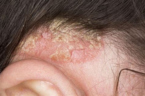 Effective Relief of Scalp Psoriasis May Be in Sight