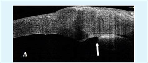 A: ASOCT arrow showing peripheral anterior synechiae near graft host... | Download Scientific ...