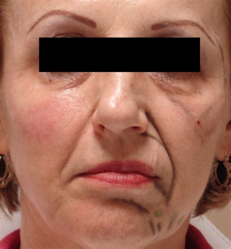 Picture of immediate results with Sculptra - Advanced Rejuvenation Medical Spa