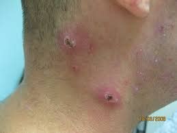 Folliculitis is Caused By Blocked Hair Follicles in the Neck Area