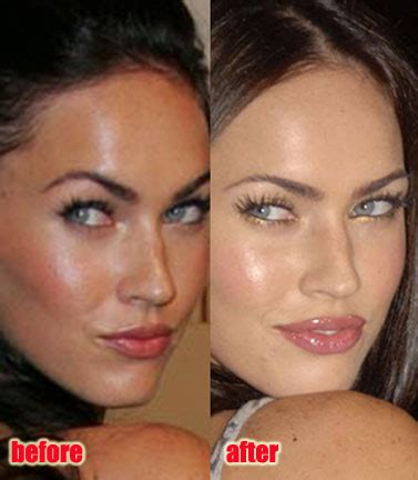 Megan Fox Lip Surgery | Lam Facial Plastic Surgery Center