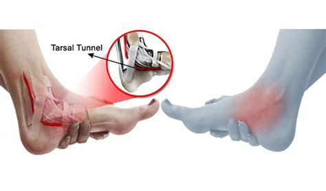 What is tarsal tunnel syndrome? Symptoms and treatment.