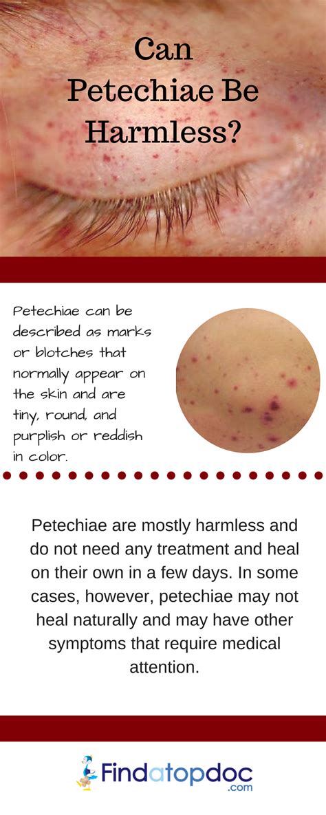 What is Petechiae, and What are its Causes.