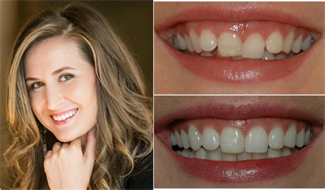 Invisalign Braces Provided in Boulder, CO | Incredible Smiles